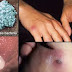 obat gonore herbal thumbnail