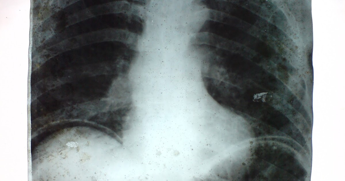 General Surgery Clinics A Surgeon's Blog Causes of Free Gas Under The Diaphragm