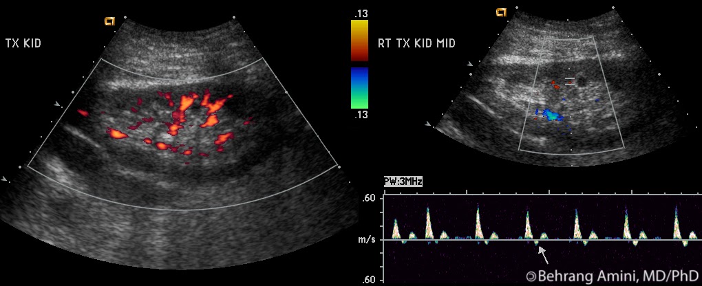 Roentgen Ray Reader: Renal Ultrasound in Transplanted Kidneys