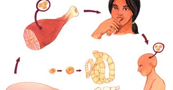 Ψ Vida Saludable: Disfrútala: NEUROCISTICERCOSIS