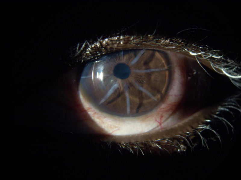 Post Lasik