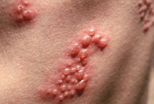 Penyakit Herpes Kulit