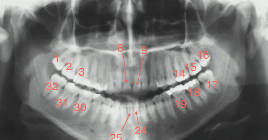 Teeth Numbers for Radiology - RadiologyER teeth diagram numbers 