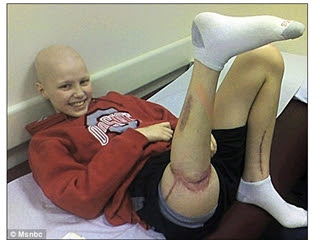 美罹癌少年接回右腿 腳跟朝前腳趾朝後