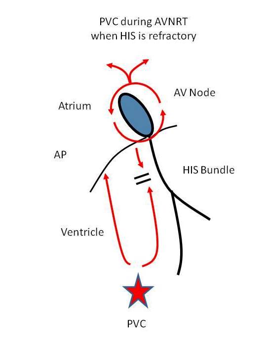 avnrt