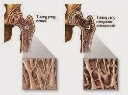 Bahaya Tulang Rapuh (Osteoporosis) Bahaya Tulang Rapuh (Osteoporosis)