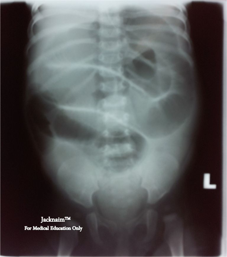 Intussusception X Ray