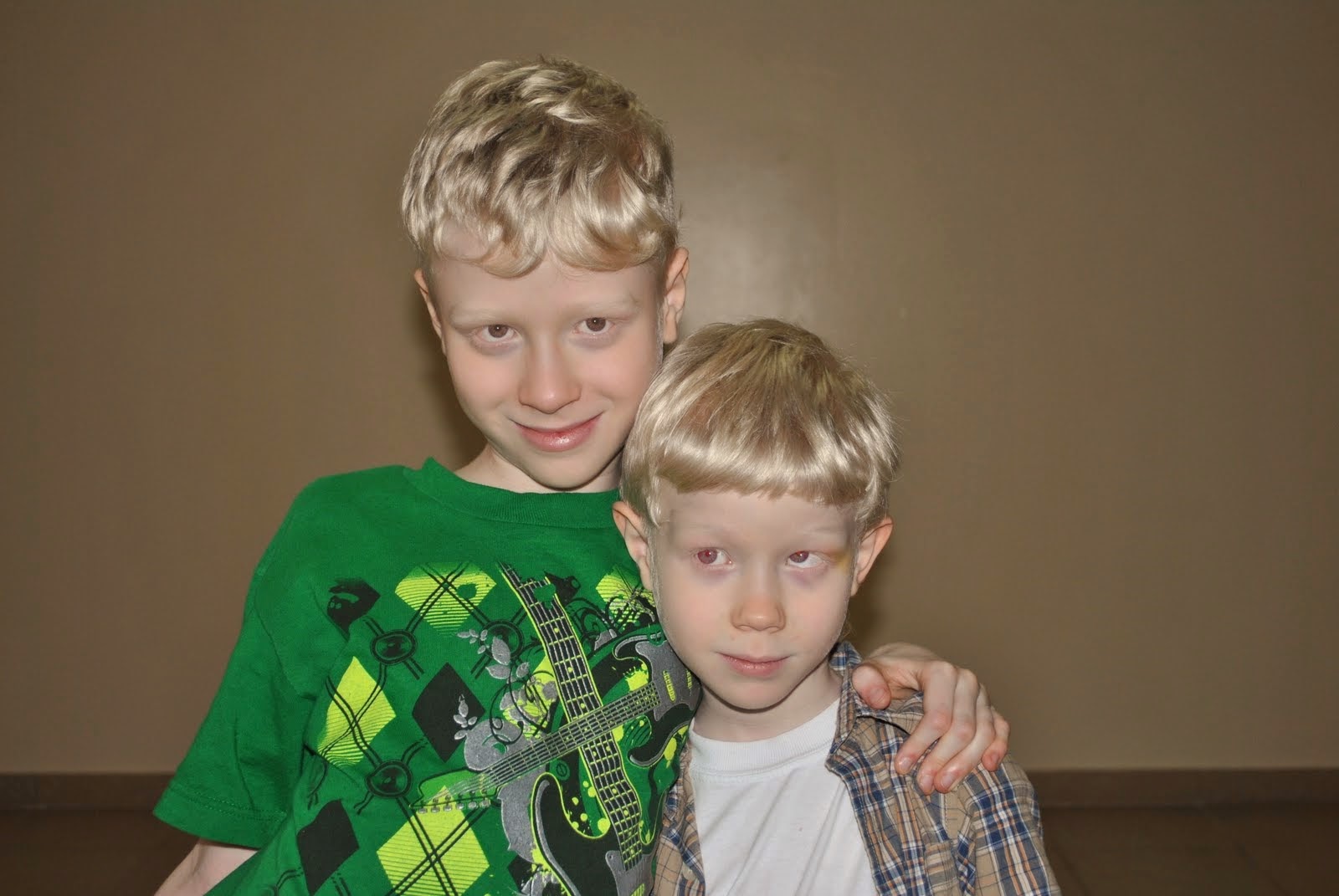 Enfermedad genética Albinismo > Síndrome de HermanskyPudlak