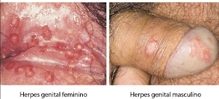 Foto cara mengobati herpes genital