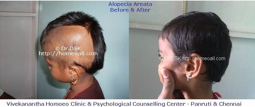  அலோபீசியா ஏரியேட்டா, alopecia areata specialist clinic chennai, puluvettu sikichai chennai velachery,