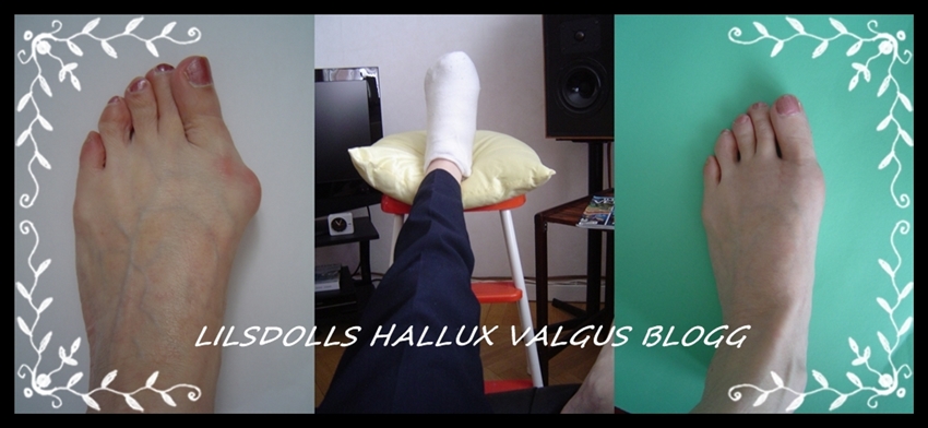 Hallux Valgus Operation Lilsdolls 