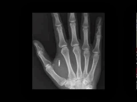 Misteri Implan Microchip 666 Mondex Pada Tubuh Manusia