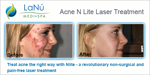 N Lite Laser Treatment for Acne