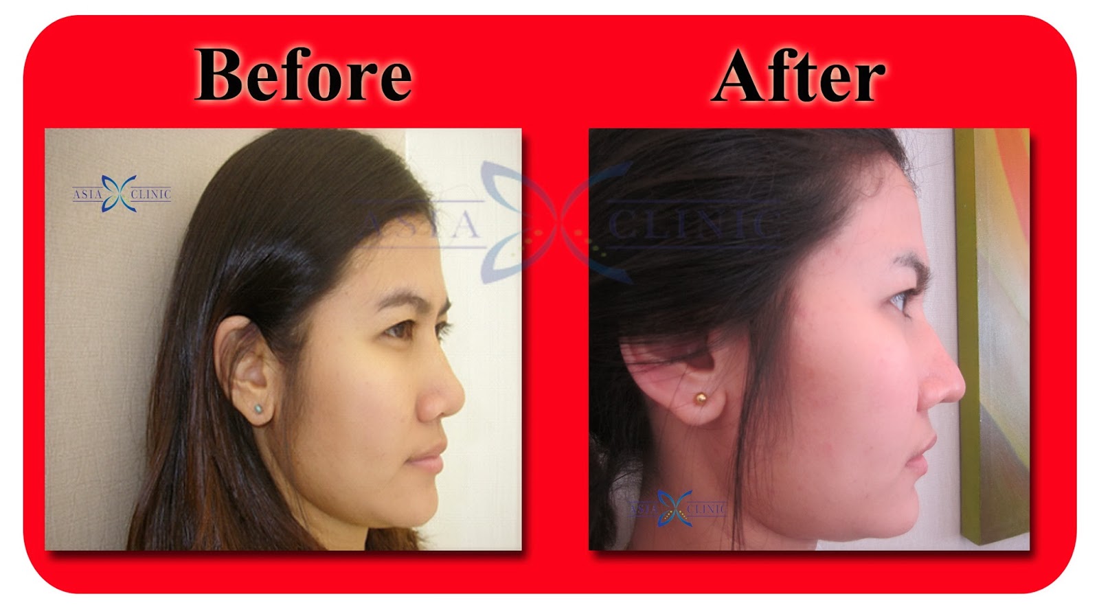 Rhinoplasty Surgery Thailand Nose Augmentation Before And After Photos