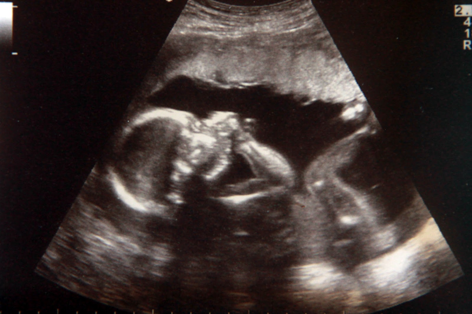 Can dating scan at 4 weeks