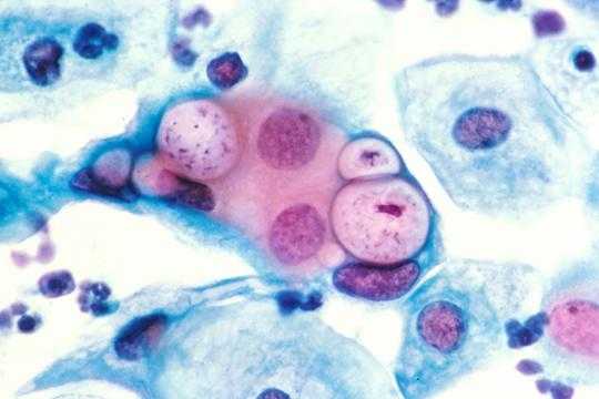 Chlamydia treatment for women azithromycin tablets Chlamydia treatment for women azithromycin tablets
