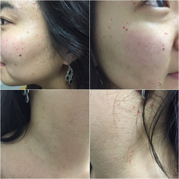 Renewme Skin Clinic Flat Wart Removal Session with CO2 Laser in Seoul