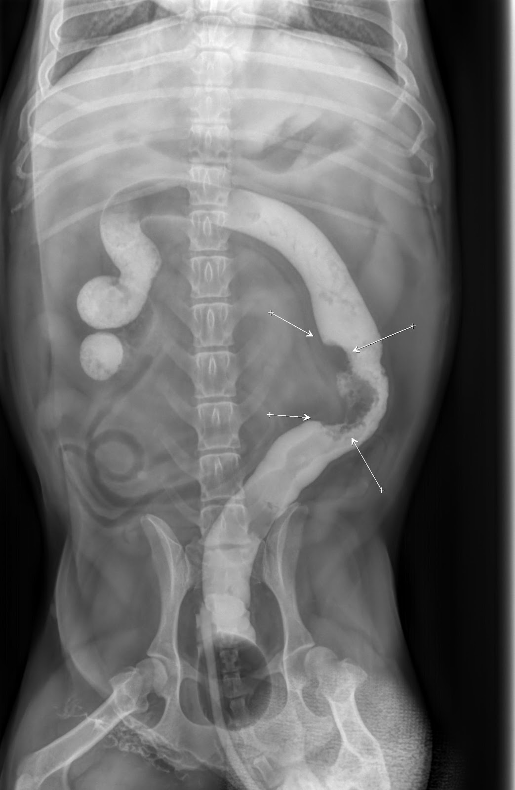 Is Rectal Cancer Surgery Possible picture foto Is Rectal Cancer Surgery Possible