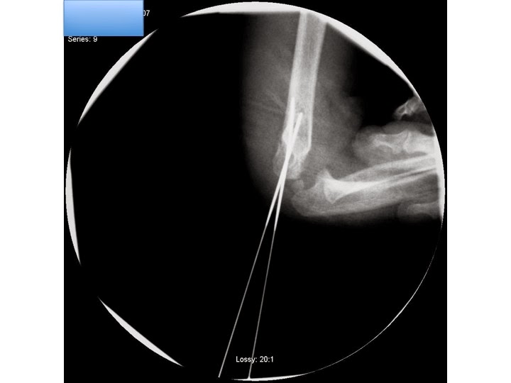 Proximal Humeral Fracture Patient regained all ROM after fixation and had no complication-4.bp.blogspot.com