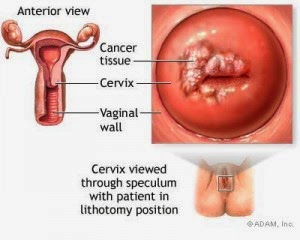 Image Obat Herbal Kanker Serviks Ampuh