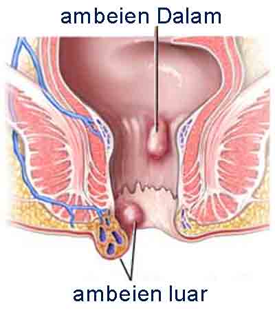 cara menyembuhkan Hemorrhoid
