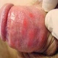 sipilis pria sipilis pria
