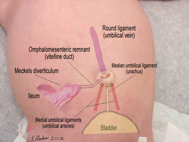 Pathophysiology of hydrocele in adults