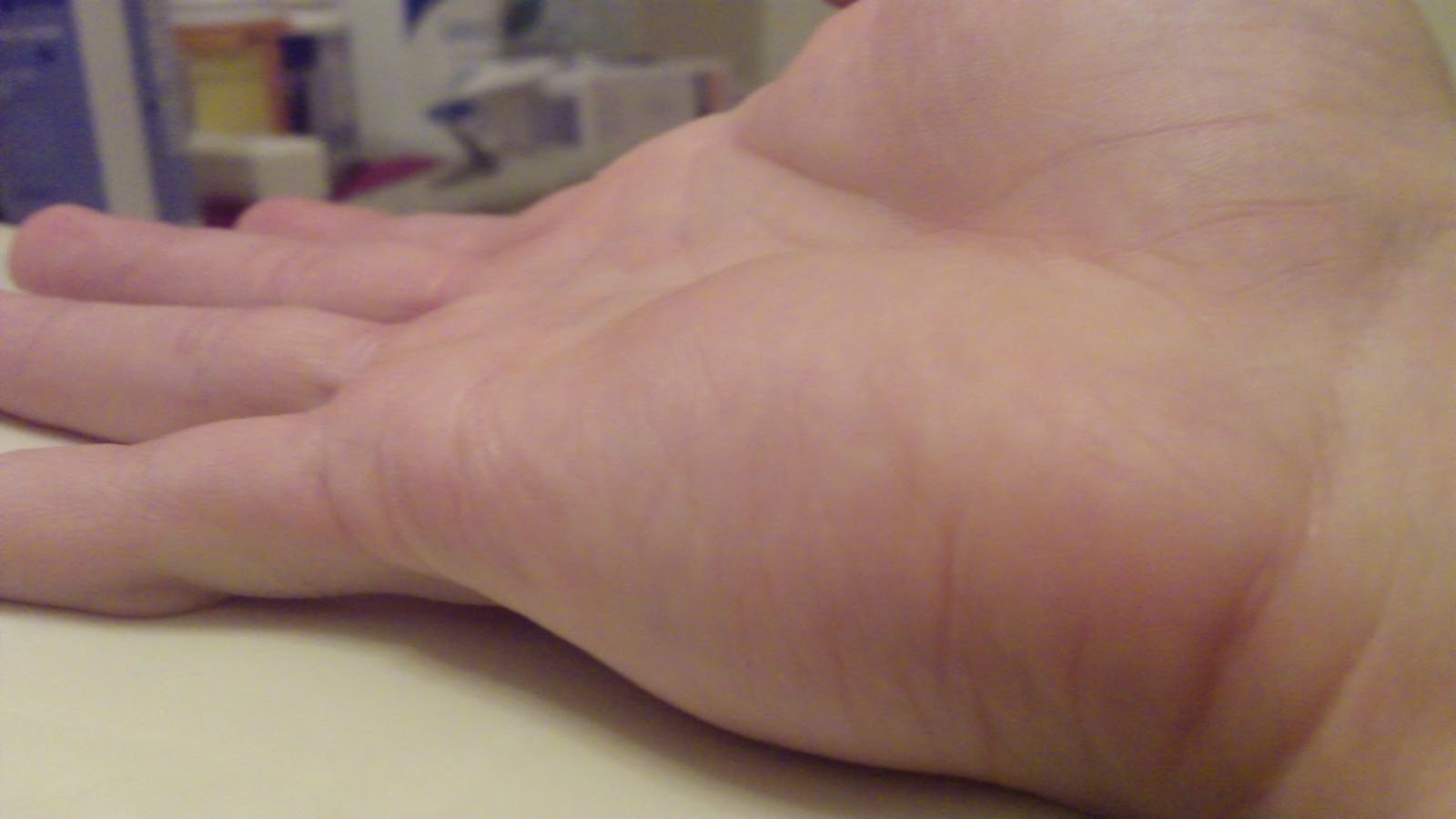 fat cyst