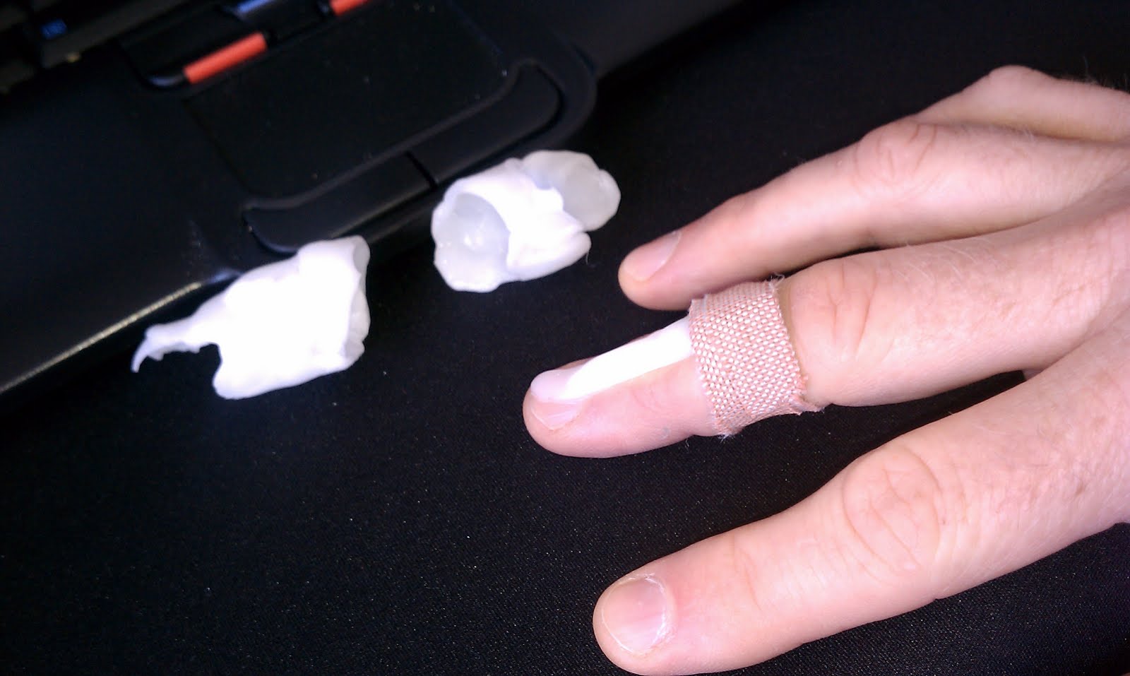 custom finger tip splint