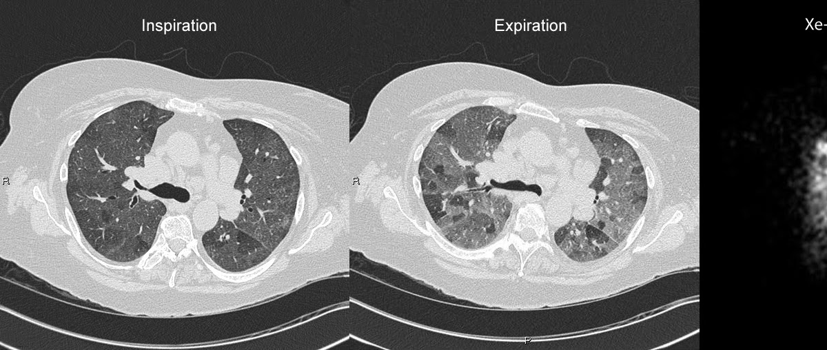 Roentgen Ray Reader Mosaic Attenuation