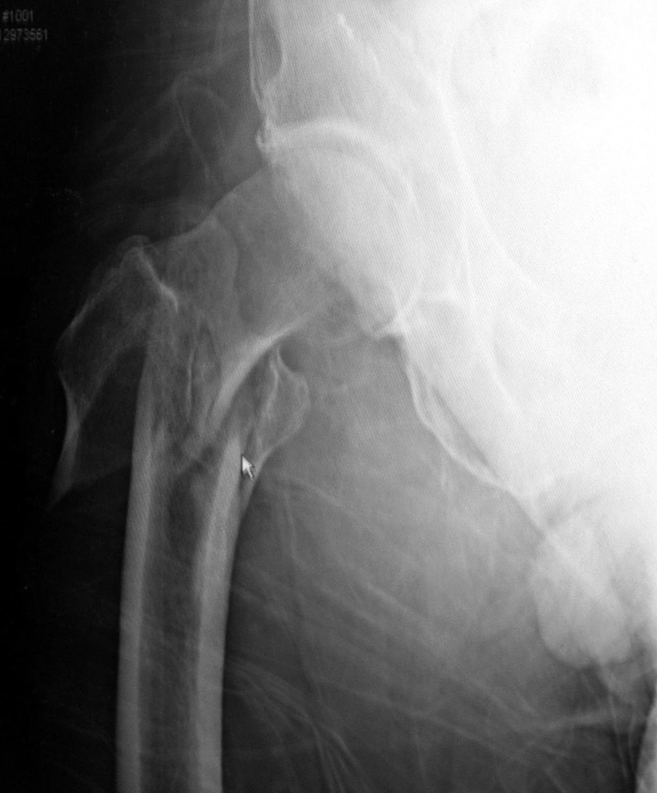 Femur Fractures John Penhune's Fractured Right Femur-4.bp.blogspot.com