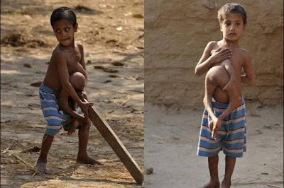 Indian Conjoined Twins pictures