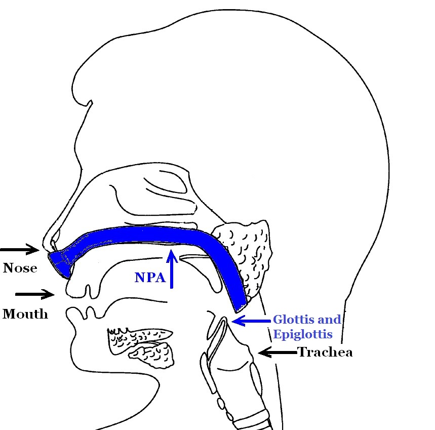 Laryngospasm, hypoxia, excited delirium, and ketamine Part I