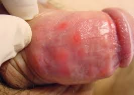 Obat Sipilis Gang jie ghosiah Ampuh Obat Sipilis Gang jie ghosiah Ampuh