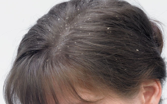 Get Rid Severe Dog Dandruff Get Rid Severe Dog Dandruff