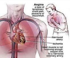 Angina Pectoris