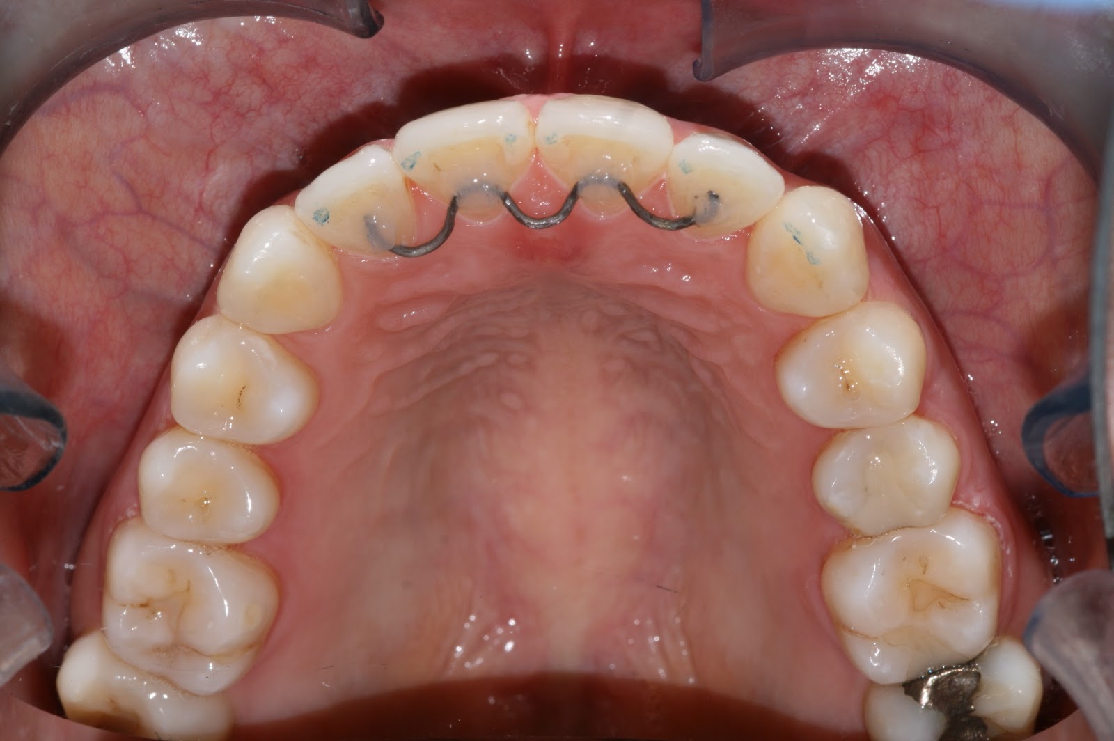 permanent lower retainer