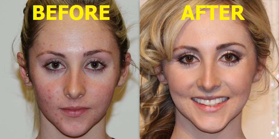 Get Clear Skin Max Acne Treatment