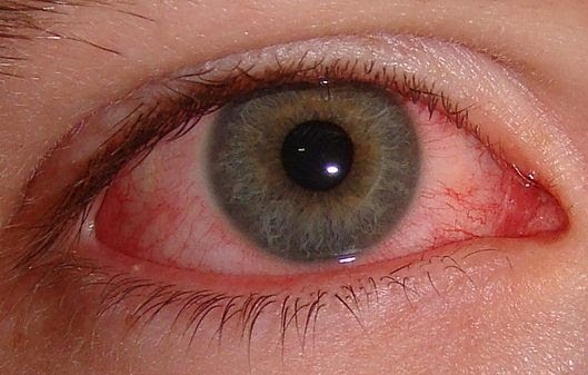 chemical burn eye