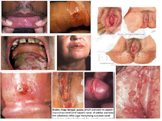 Obat Kencing Nanah Dan Sipilis Di De Nature Obat Kencing Nanah Dan Sipilis Di De Nature