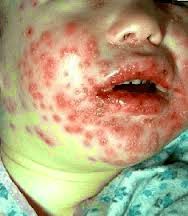 Herpes Anak Herpes Anak