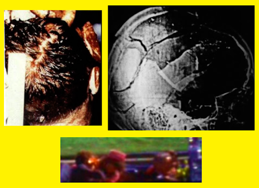 JFK-Head-Wound-Photographic-Comparison.png