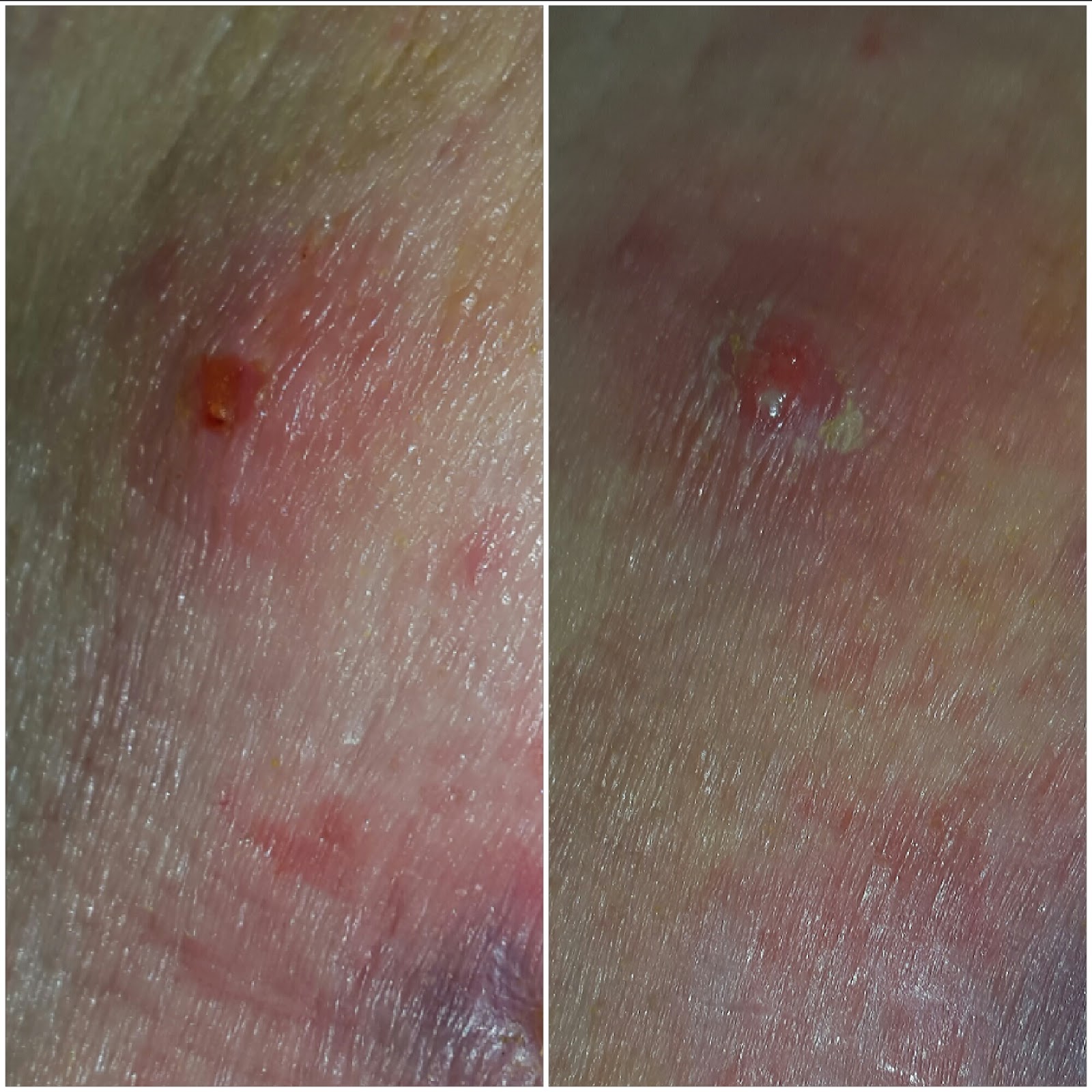 Mrsa Treatment Natural Remedies Mrsa Treatment Natural Remedies