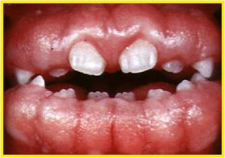 external image gingival+fibromatosis.jpg