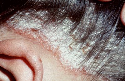 Home Remedies For Itchy Scalp With Dreadlocks Home Remedies For Itchy Scalp With Dreadlocks