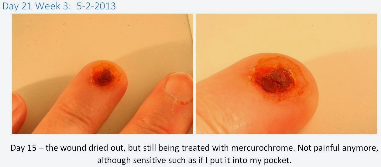 Personal Touch Works Recovery from a ripped off finger nail