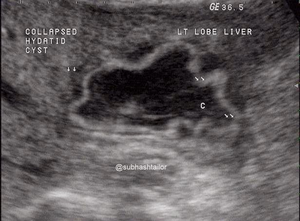 SONO DIGEST: ULTRASOUND IN HYDATID DISEASE