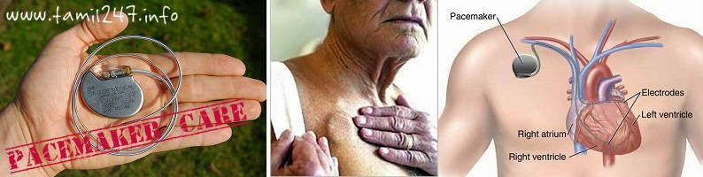 Pacemaker care for heart patients, Pacemakerudan valvadhu sulabama, pacemaker udan vazhvadhu eppadi, Idhaya noikku pacemaker price