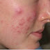 Skin problems and their treatment