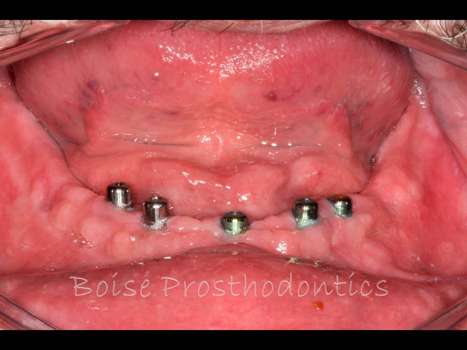 Boise Idaho Prosthodontics Picture Sequence of Maxillary Complete